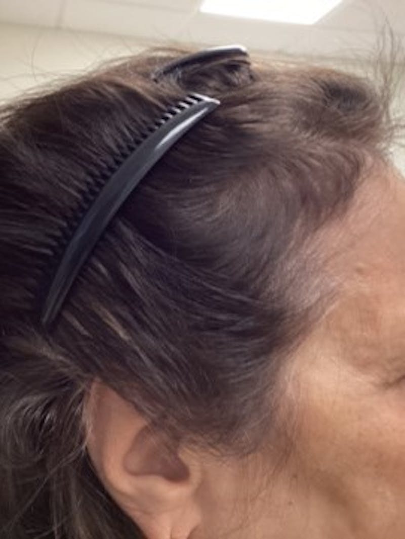 Androgenic Alopecia Before & After Gallery - Patient 304109 - Image 2