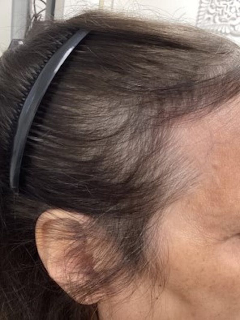 Androgenic Alopecia Before & After Gallery - Patient 304109 - Image 1