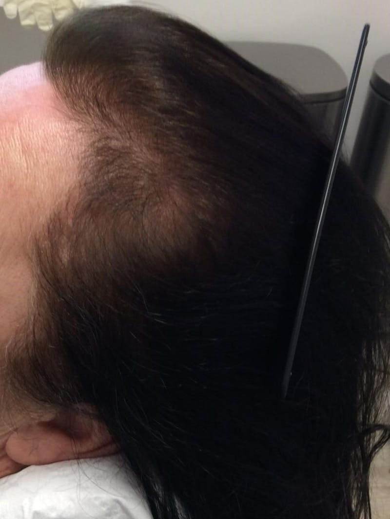 Androgenic Alopecia Before & After Gallery - Patient 175829 - Image 2