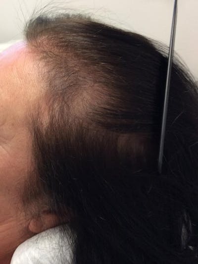 Androgenic Alopecia Before & After Gallery - Patient 175829 - Image 1