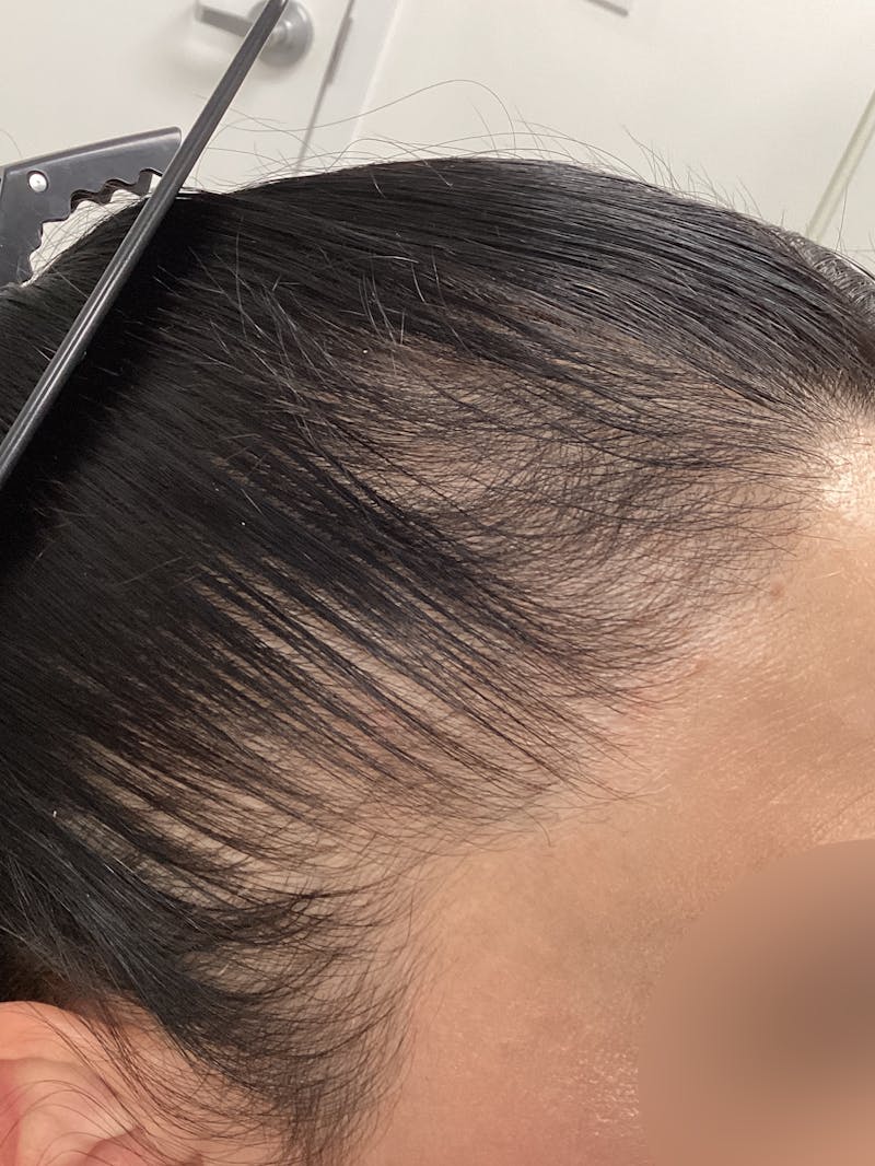 Androgenic Alopecia Before & After Gallery - Patient 336671 - Image 1