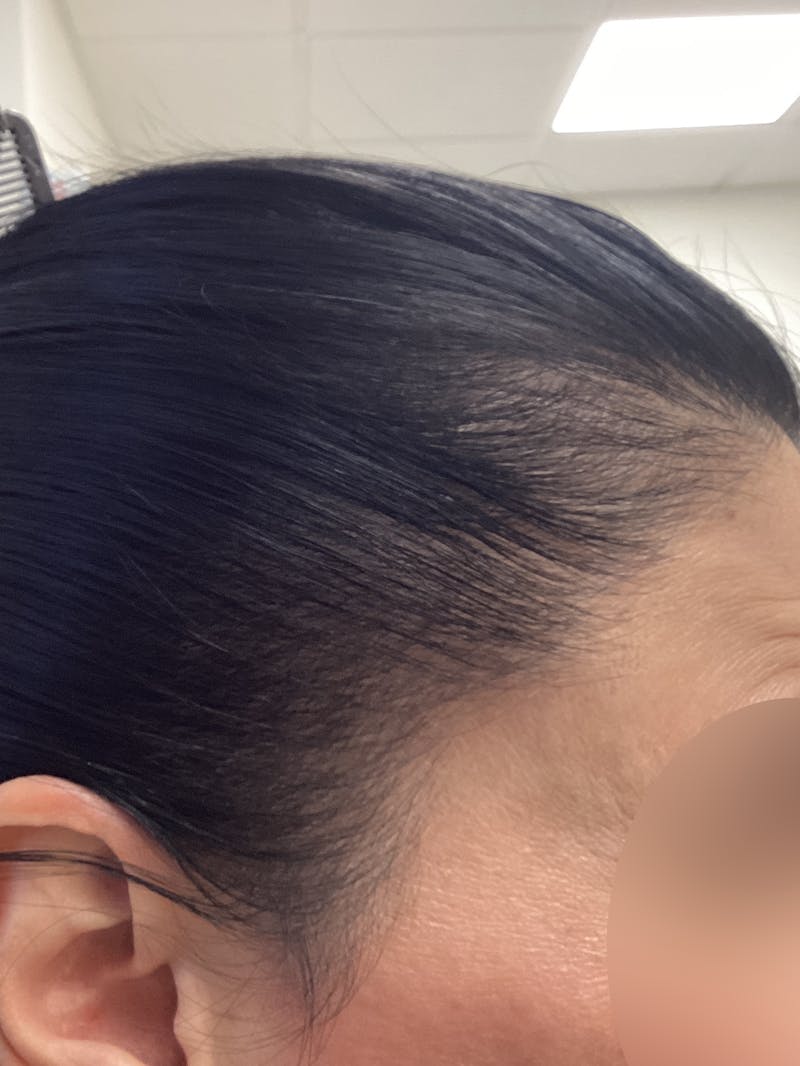 Androgenic Alopecia Before & After Gallery - Patient 336671 - Image 2