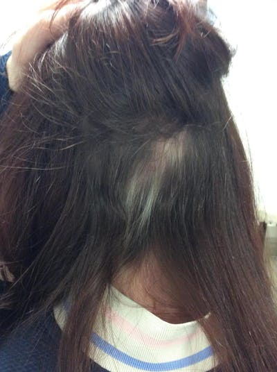 Alopecia Areata Before & After Gallery - Patient 292376 - Image 2