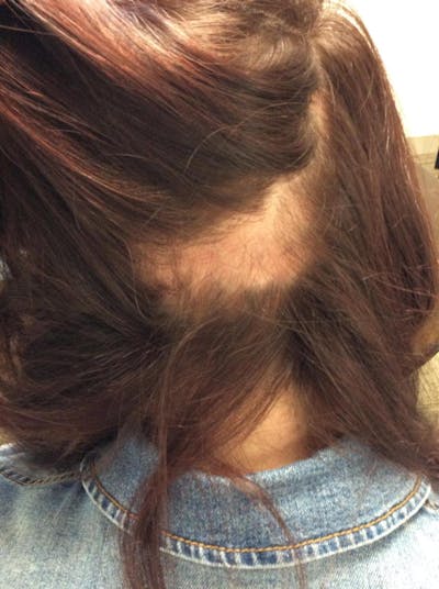 Alopecia Areata Before & After Gallery - Patient 292376 - Image 1
