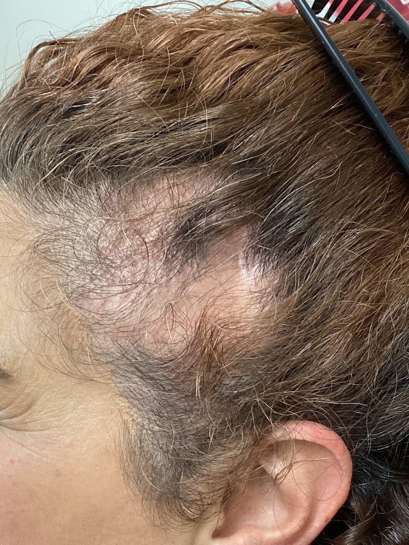 Alopecia Areata Before & After Gallery - Patient 368599 - Image 2