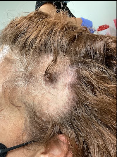 Alopecia Areata Before & After Gallery - Patient 368599 - Image 1