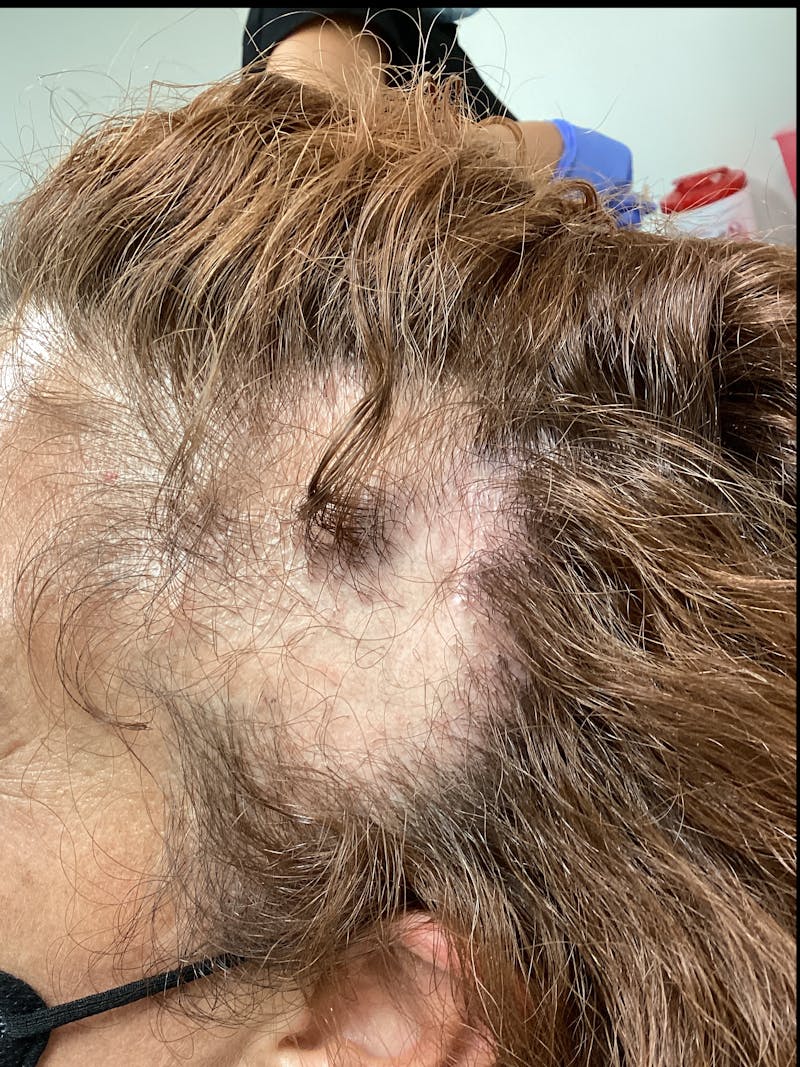 Alopecia Areata Before & After Gallery - Patient 368599 - Image 1