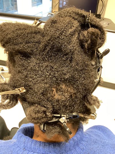 Alopecia Areata Before & After Gallery - Patient 365360 - Image 2