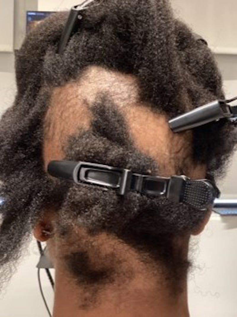 Alopecia Areata Before & After Gallery - Patient 365360 - Image 1