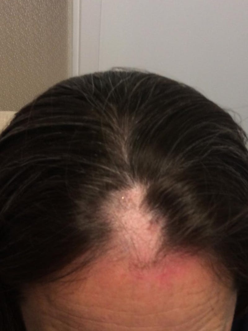 Low Level Laser Therapy Before & After Gallery - Patient 278563 - Image 1