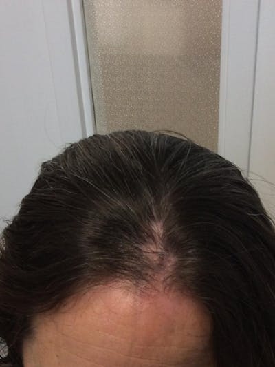 Alopecia Areata Before & After Gallery - Patient 246079 - Image 2