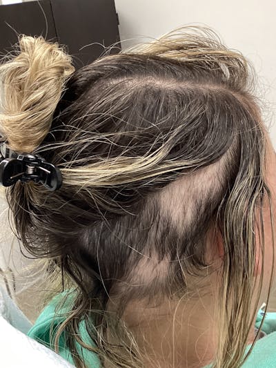 Alopecia Areata Before & After Gallery - Patient 220336 - Image 2