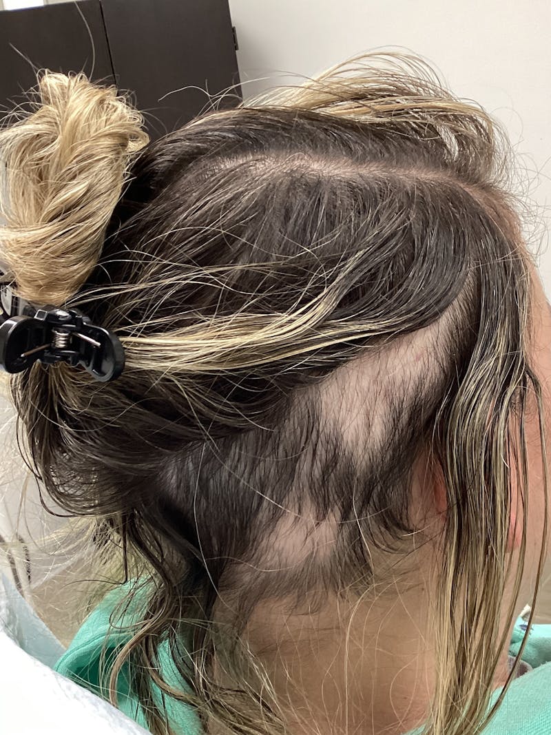 Alopecia Areata Before & After Gallery - Patient 220336 - Image 2