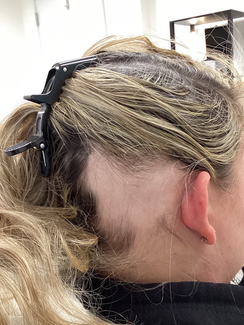 Alopecia Areata Before & After Gallery - Patient 220336 - Image 1