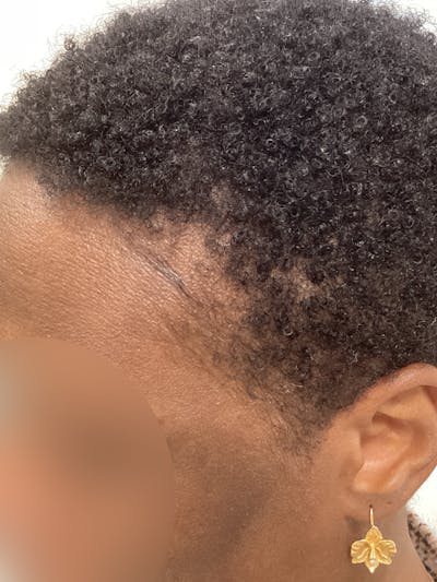 Alopecia Areata Before & After Gallery - Patient 285434 - Image 2