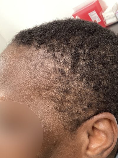 Alopecia Areata Before & After Gallery - Patient 285434 - Image 1