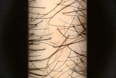 Scalp Exfoliation Before & After Gallery - Patient 370297 - Image 2