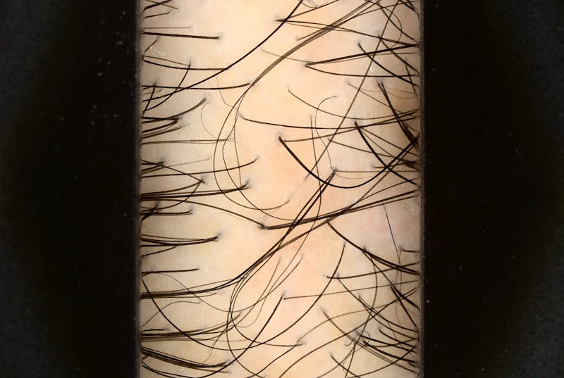 Scalp Exfoliation Before & After Gallery - Patient 370297 - Image 2