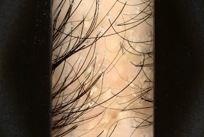 Scalp Exfoliation Before & After Gallery - Patient 370297 - Image 1