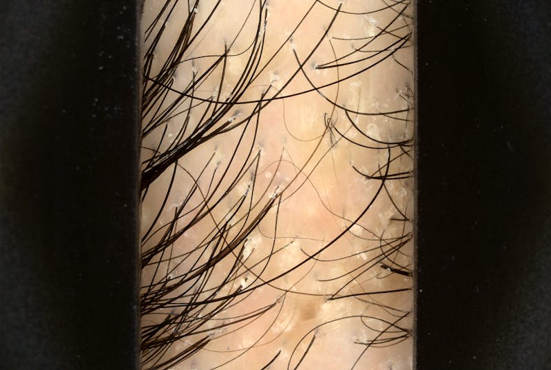 Scalp Exfoliation Before & After Gallery - Patient 370297 - Image 1