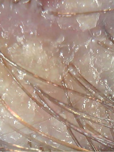 Scalp Exfoliation Before & After Gallery - Patient 285865 - Image 1