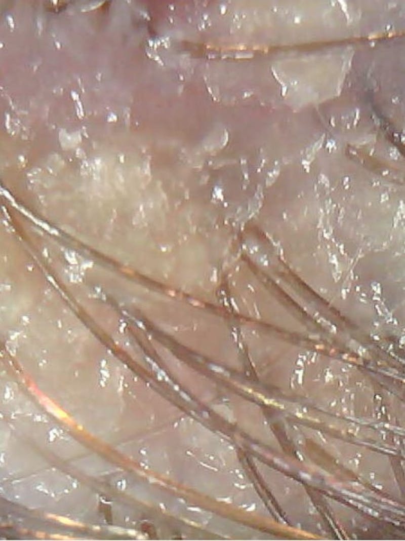 Scalp Exfoliation Before & After Gallery - Patient 285865 - Image 1