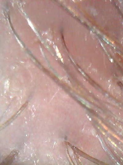 Scalp Exfoliation Before & After Gallery - Patient 285865 - Image 2