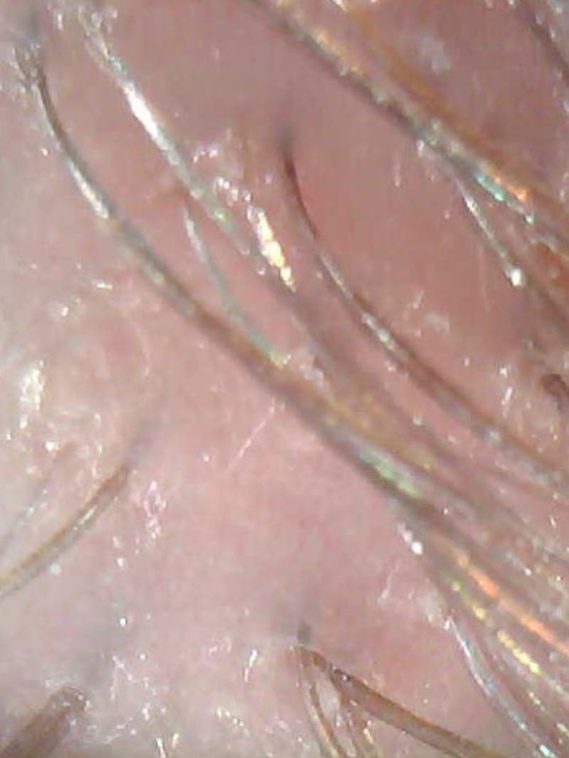 Scalp Exfoliation Before & After Gallery - Patient 285865 - Image 2