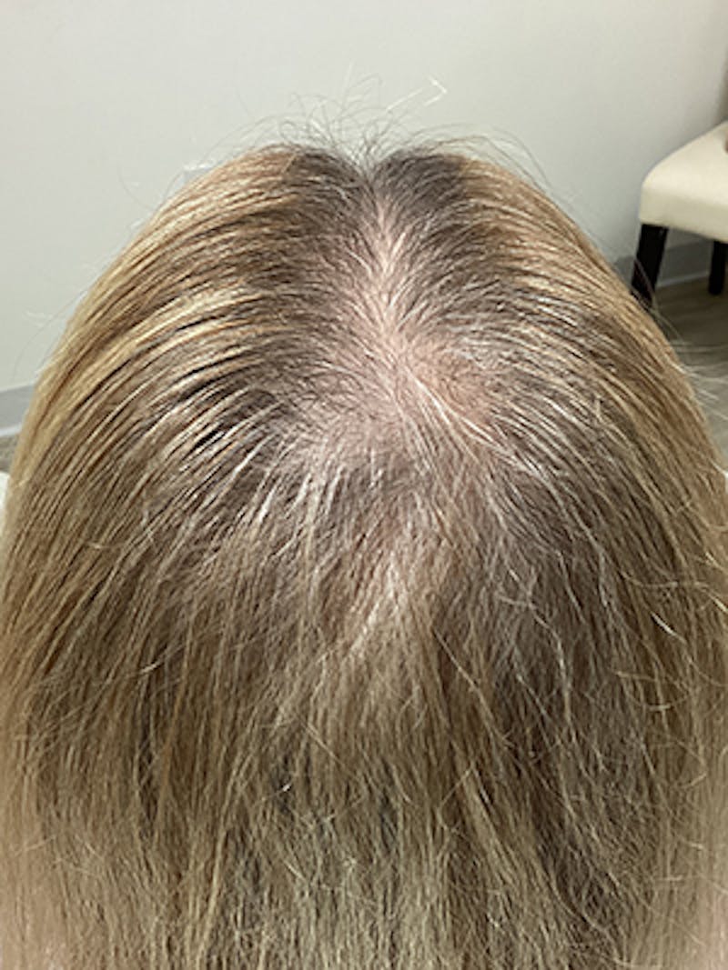 Painless PRP Before & After Gallery - Patient 111312 - Image 2