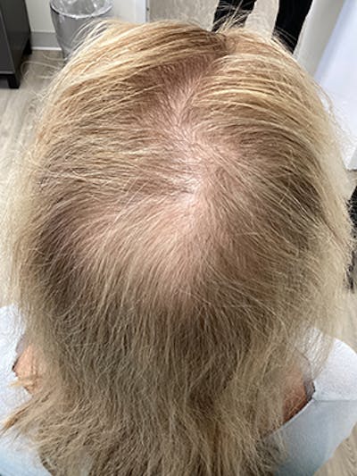 Painless PRP Before & After Gallery - Patient 111312 - Image 1