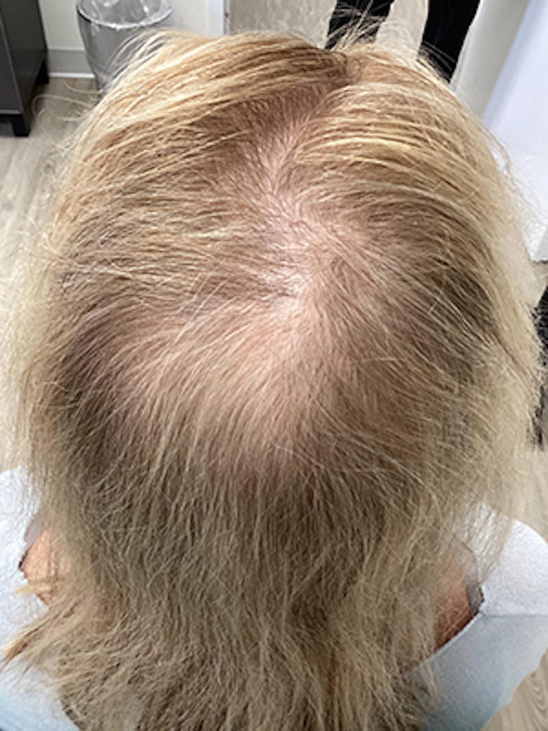 Painless PRP Before & After Gallery - Patient 111312 - Image 1