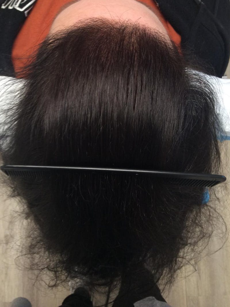 Painless PRP Before & After Gallery - Patient 337270 - Image 2