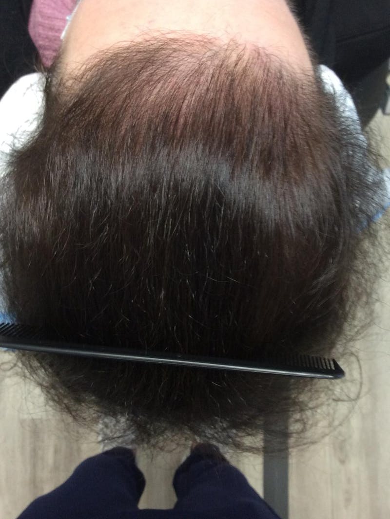 Painless PRP Before & After Gallery - Patient 337270 - Image 1
