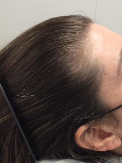 Painless PRP Before & After Gallery - Patient 943808 - Image 1