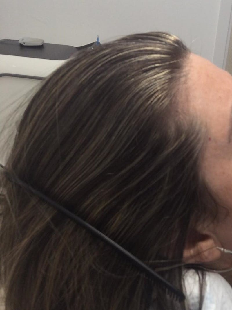 Painless PRP Before & After Gallery - Patient 943808 - Image 2