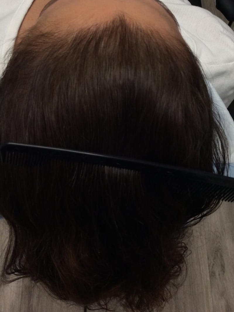 Painless PRP Before & After Gallery - Patient 246818 - Image 2