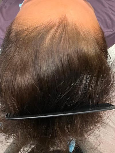 Painless PRP Before & After Gallery - Patient 246818 - Image 1