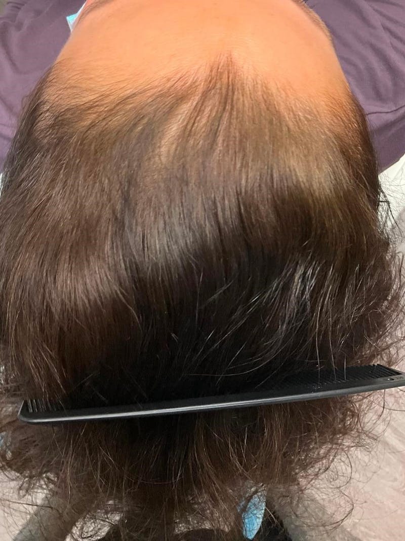 Painless PRP Before & After Gallery - Patient 246818 - Image 1