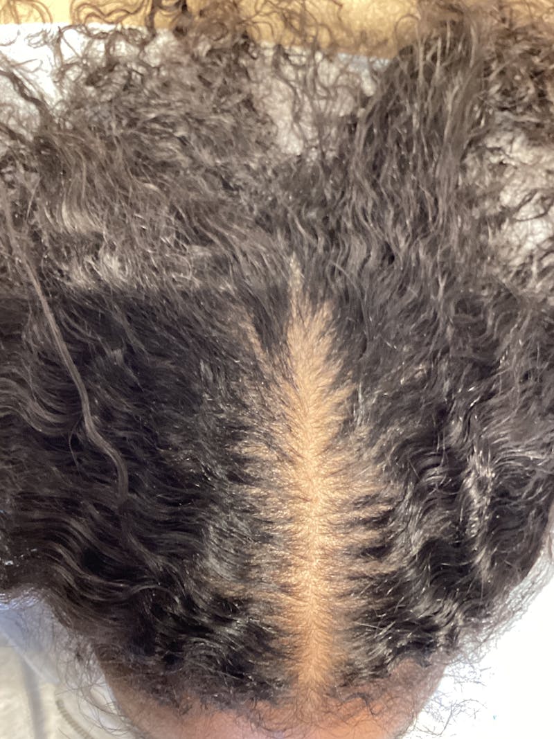Painless PRP Before & After Gallery - Patient 836191 - Image 2