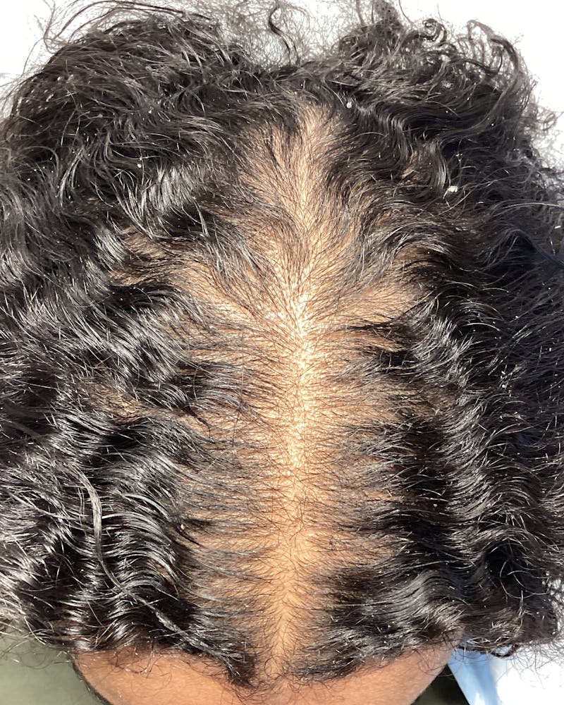 Painless PRP Before & After Gallery - Patient 836191 - Image 1