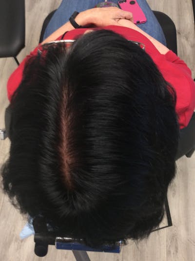Low Level Laser Therapy Before & After Gallery - Patient 347581 - Image 2