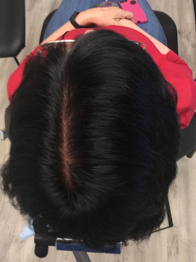 Low Level Laser Therapy Before & After Gallery - Patient 347581 - Image 2