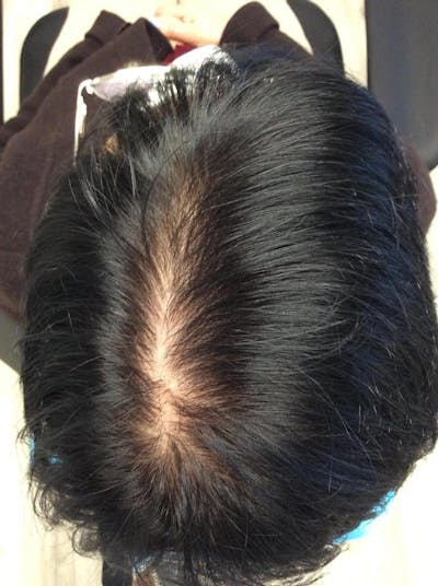 Low Level Laser Therapy Before & After Gallery - Patient 347581 - Image 1