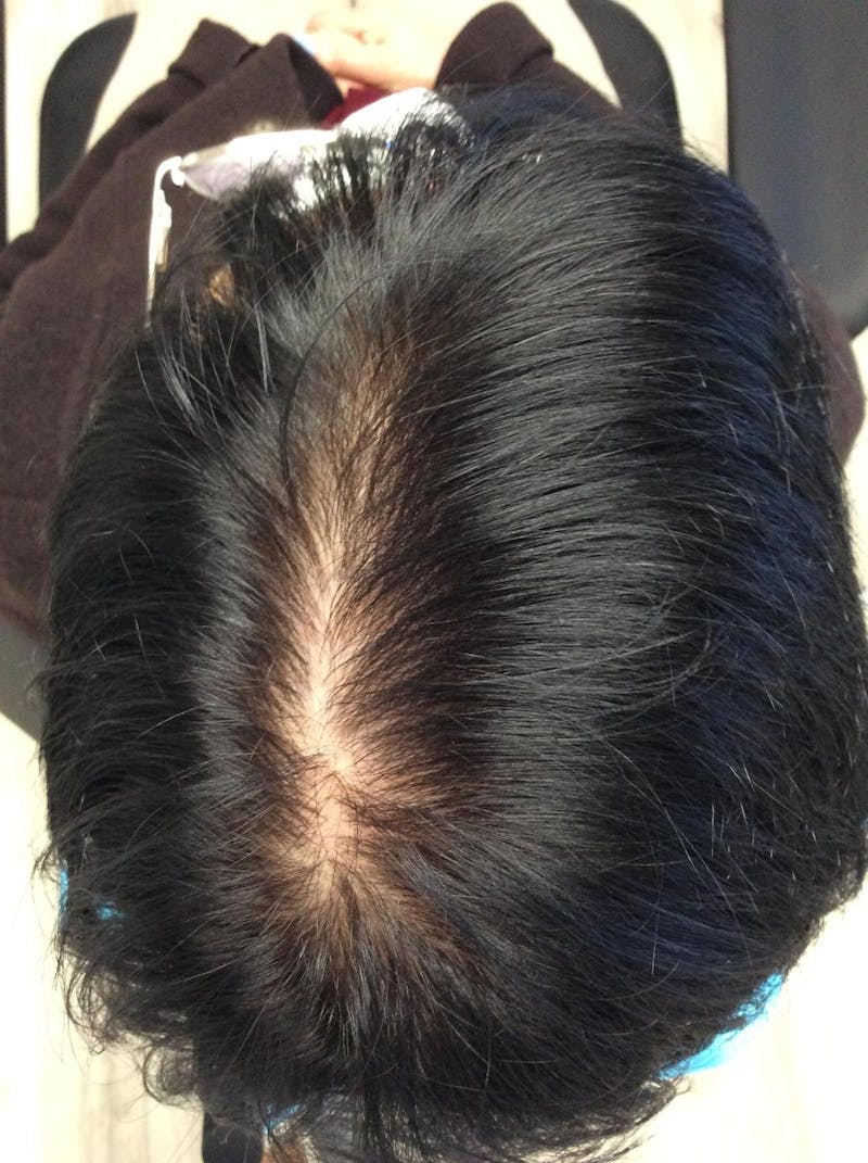 Low Level Laser Therapy Before & After Gallery - Patient 347581 - Image 1