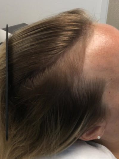 Low Level Laser Therapy Before & After Gallery - Patient 186233 - Image 2