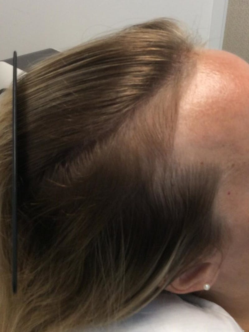 Low Level Laser Therapy Before & After Gallery - Patient 186233 - Image 2