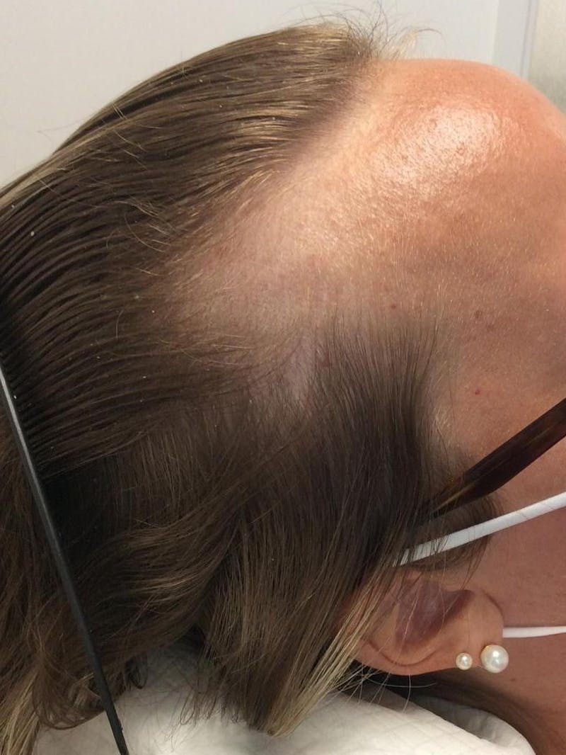 Low Level Laser Therapy Before & After Gallery - Patient 186233 - Image 1