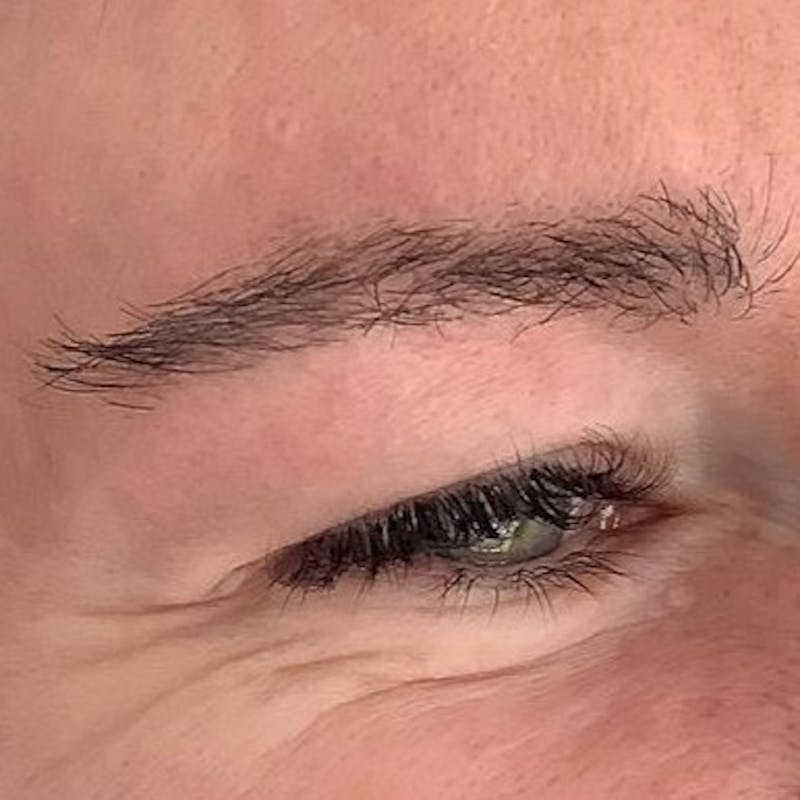 Eyebrow Transplant Before & After Gallery - Patient 286001 - Image 2