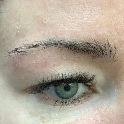 Eyebrow Transplant Before & After Gallery - Patient 286001 - Image 1