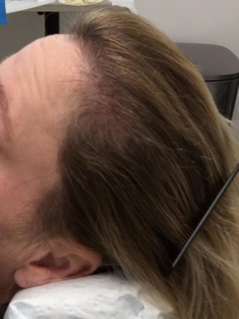 Low Level Laser Therapy Before & After Gallery - Patient 368377 - Image 2